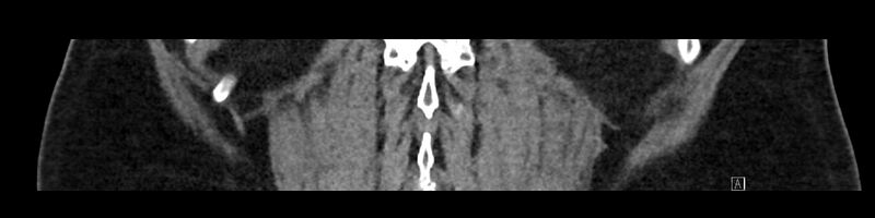 File:Buried bumper syndrome - gastrostomy tube (Radiopaedia 63843-72575 Coronal 78).jpg
