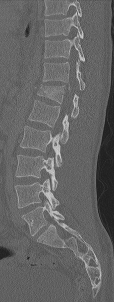 File:Burst fracture - T12 with conus compression (Radiopaedia 56825-63647 Sagittal bone window 35).png