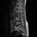 Burst fracture - lumbar spine (Radiopaedia 72877-83541 Sagittal T1 8).jpg