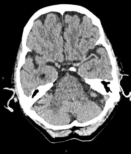 File:Calcified cerebral emboli from left ventricular thrombus (Radiopaedia 84420-99758 Axial non-contrast 68).jpg