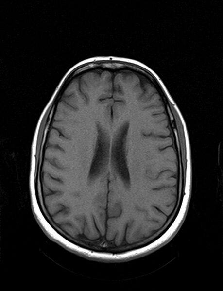 File:Calcified cerebral hydatid cyst (Radiopaedia 65603-74699 Axial T1 15).jpg