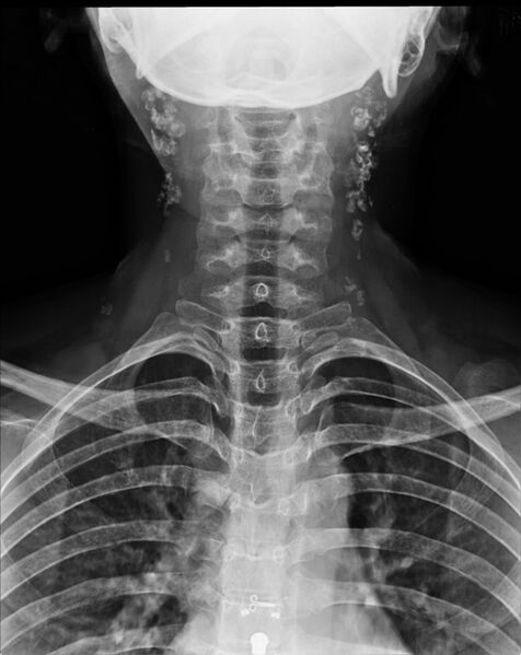 File:Calcified cervical nodes (Radiopaedia 23030-23058 Frontal 1).jpg