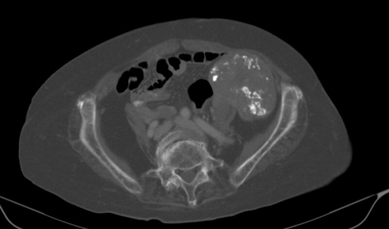 File:Calcified fibroids (Radiopaedia 20306-20228 Axial bone window 9).jpg