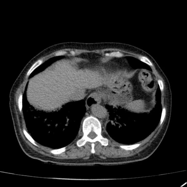 File:Calcified hepatic hydatid cyst (Radiopaedia 26872-27046 Axial non-contrast 13).jpg