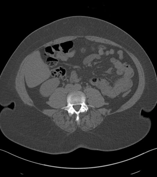 File:Calcified hepatic hydatid cyst (Radiopaedia 81127-94738 Axial non-contrast 59).jpg