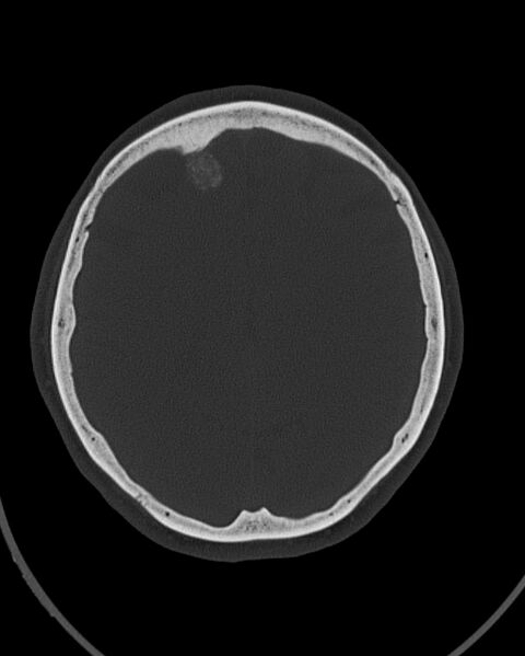 File:Calcified meningioma (Radiopaedia 74361-85243 Axial bone window 17).jpg