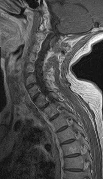 File:Calcified meningioma - cervical canal (Radiopaedia 70136-82468 Sagittal 10).jpg
