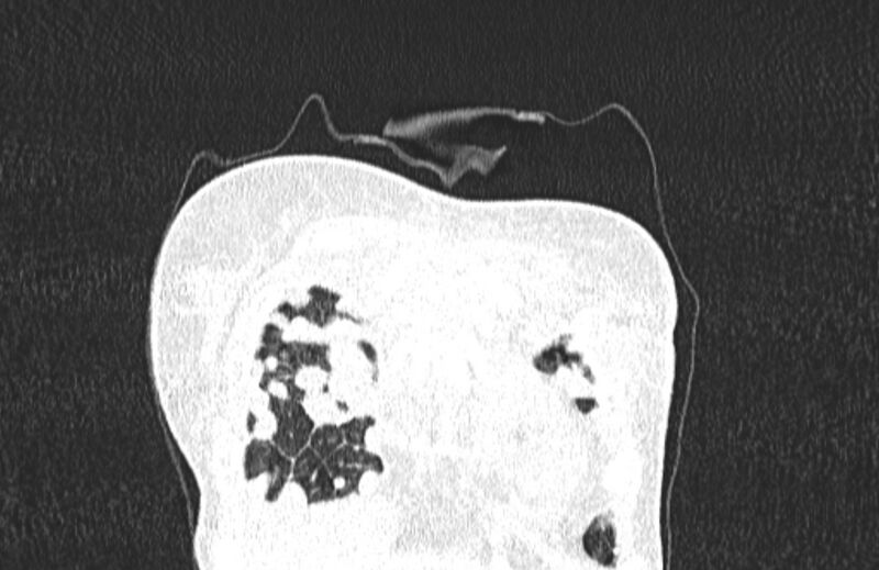 File:Cannonball metastases from breast cancer (Radiopaedia 91024-108569 Coronal lung window 14).jpg