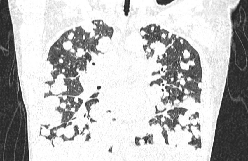 Cannonball metastases from breast cancer (Radiopaedia 91024-108569 Coronal lung window 73).jpg