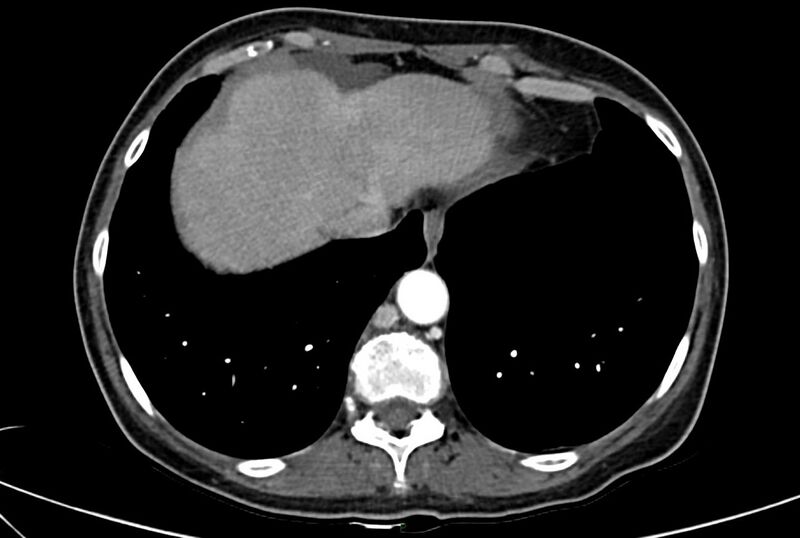 File:Carcinoid mesenteric tumor complicated by chylous ascites (Radiopaedia 76312-88926 A 6).jpg