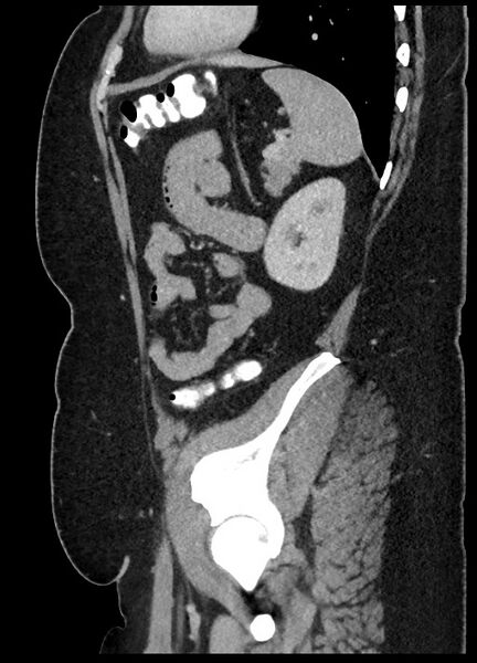 File:Carcinoid tumor - terminal ileum (Radiopaedia 60931-68739 C 18).jpg