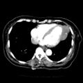 Cardiac fibroma (Radiopaedia 38974-41149 A 12).jpg