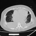 Cardiogenic pulmonary edema (Radiopaedia 29213-29609 Axial lung window 62).jpg