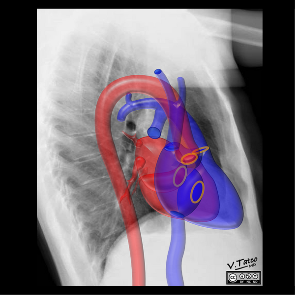 File:Cardiomediastinal anatomy on chest radiography (annotated images) (Radiopaedia 46331-50748 O 1).png