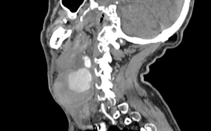 File:Carotid artery pseudoaneurysm (Radiopaedia 84030-99259 E 26).jpg