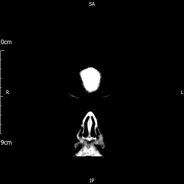 File:Cavernous sinus thrombosis (Radiopaedia 79414-92510 Coronal Brain 9).jpg