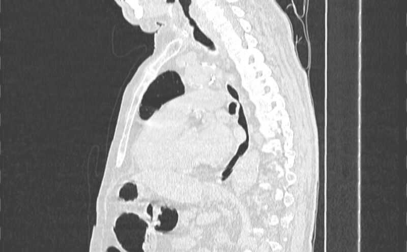 File:Cavitating bronchogenic carcinoma (Radiopaedia 44489-48162 Sagittal lung window 35).jpg