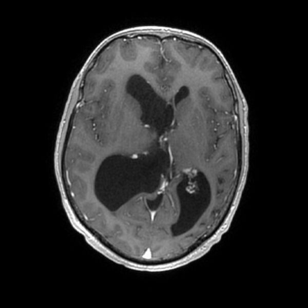 File:Central neurocytoma (Radiopaedia 67618-77021 Axial T1 C+ 14).jpg