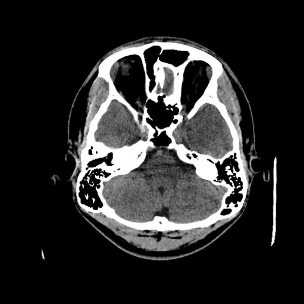 File:Central neurocytoma (Radiopaedia 79320-92379 Axial non-contrast 11).jpg