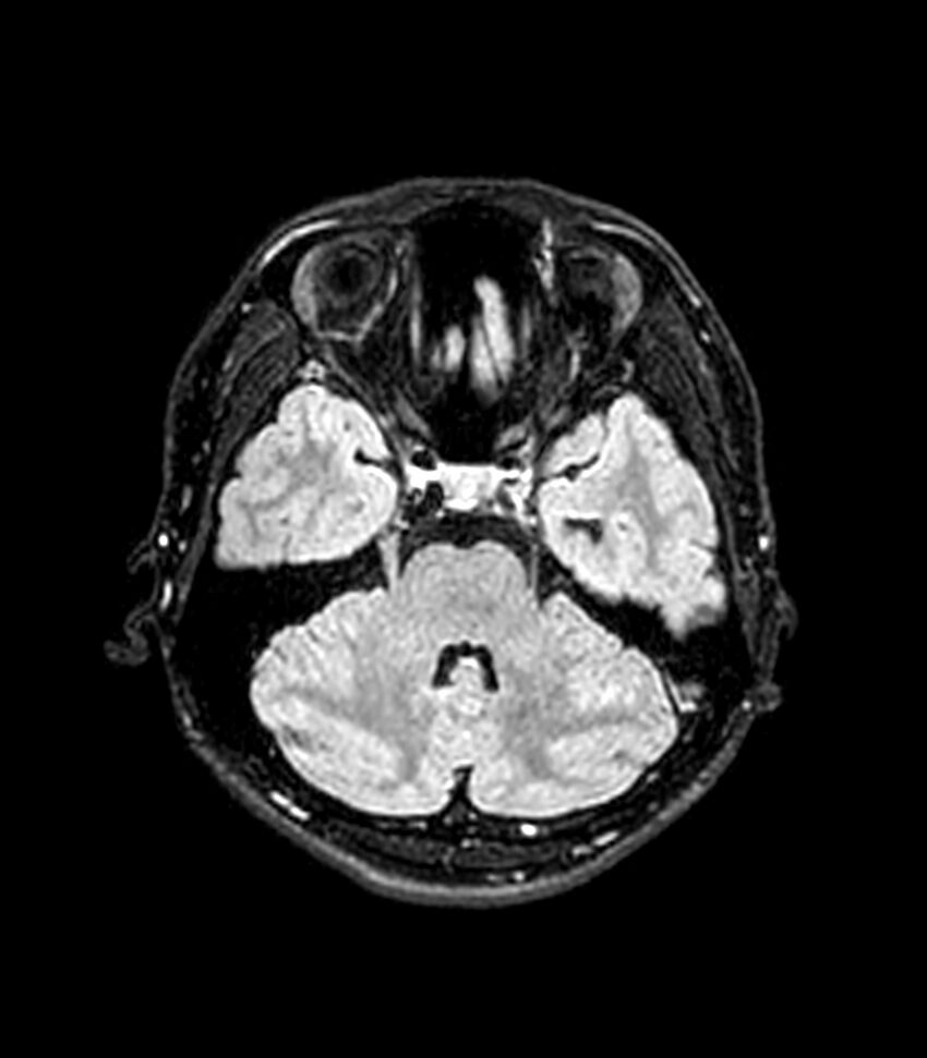 Central neurocytoma (Radiopaedia 79320-92380 Axial FLAIR 217).jpg