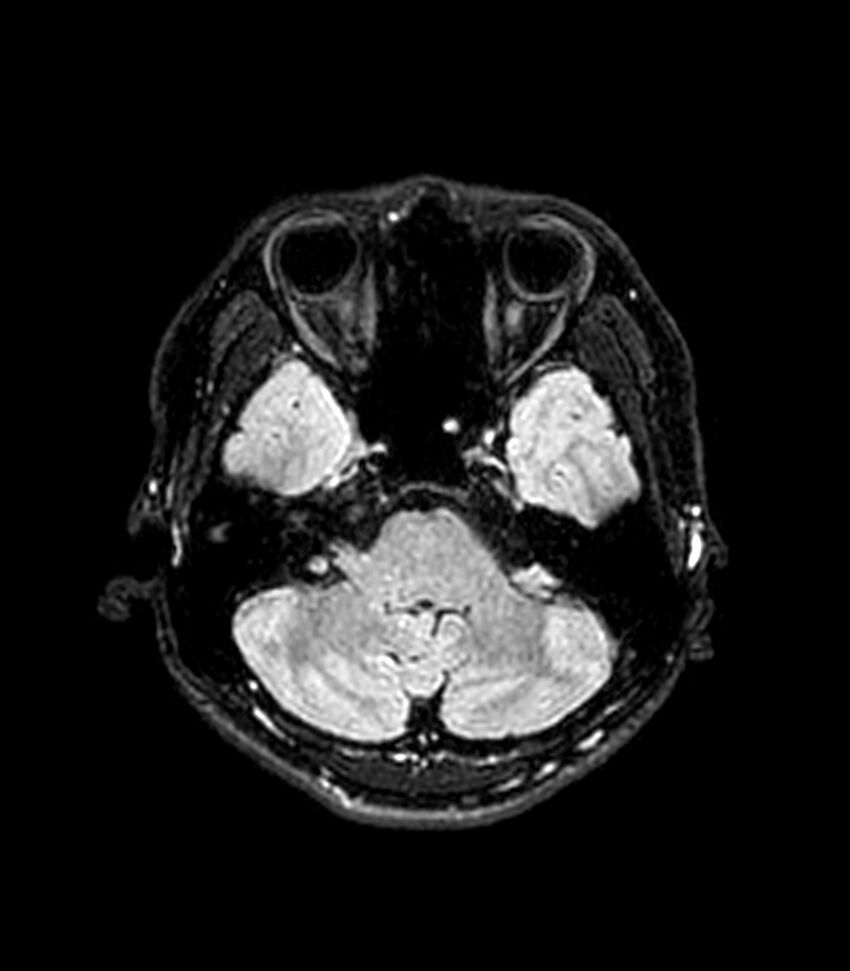 Central neurocytoma (Radiopaedia 79320-92380 Axial FLAIR 230).jpg