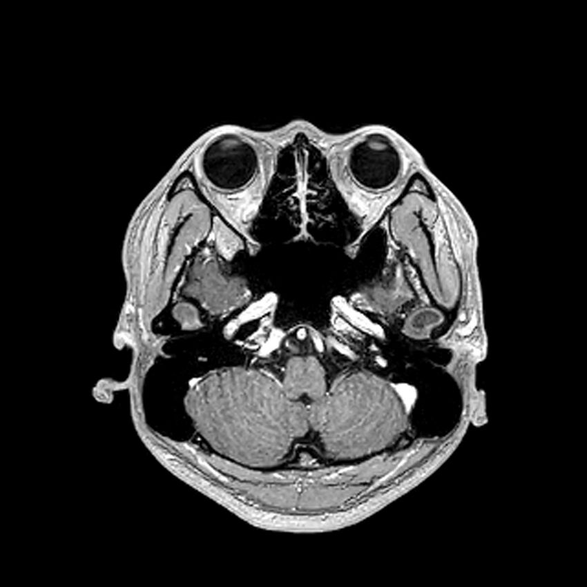 Central neurocytoma (Radiopaedia 79320-92380 Axial T1 C+ 67).jpg