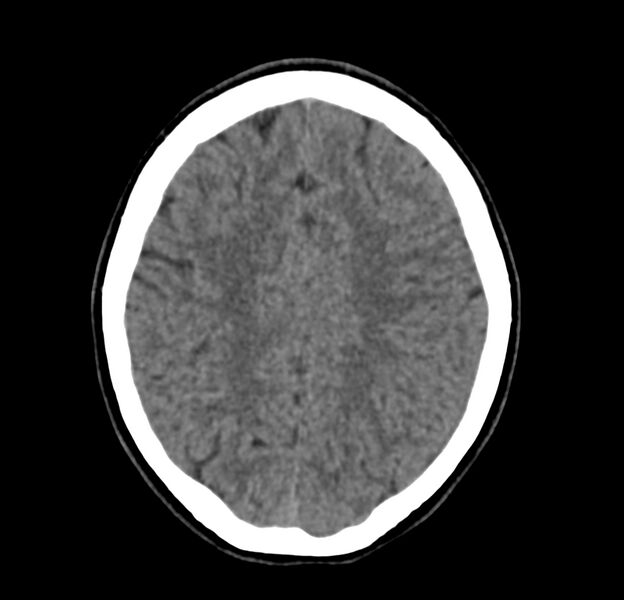 File:Cerebellar agenesis (Radiopaedia 30203-30817 Axial non-contrast 36).jpg