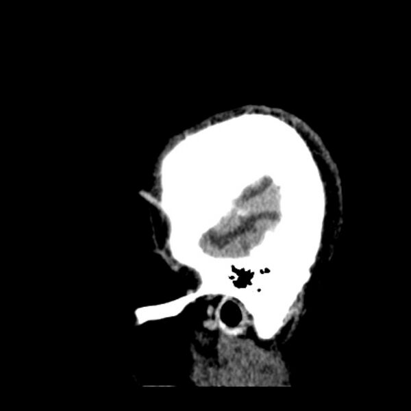 File:Cerebellar hemorrhage (Radiopaedia 27193-27359 C 42).jpg