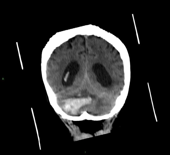 File:Cerebellar hemorrhage (Radiopaedia 58792-66026 Coronal non-contrast 21).jpg