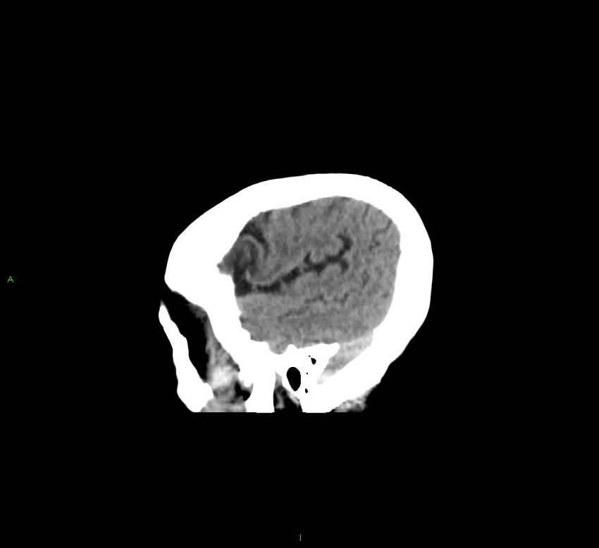 Cerebellar hemorrhage (Radiopaedia 58793-66027 C 10).jpg