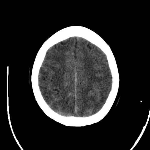 File:Cerebellar hemorrhage causing obstructive hydrocephalus (Radiopaedia 33989-35207 Axial non-contrast 40).jpg