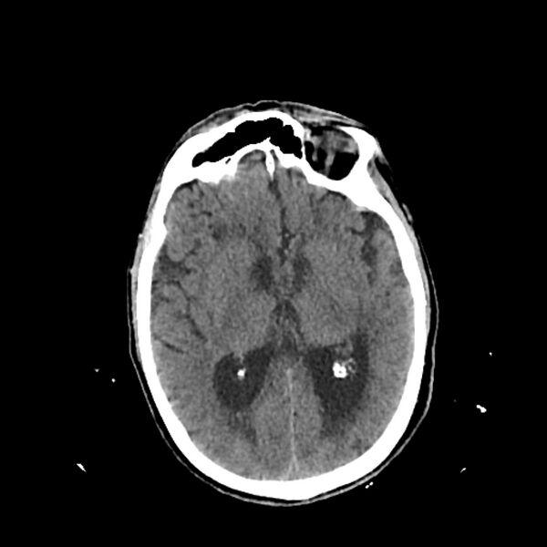 File:Cerebellar metastasis - lung tumor (Radiopaedia 69317-79145 Axial non-contrast 18).jpg