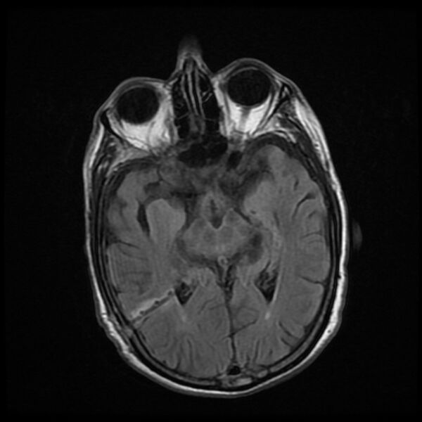 File:Cerebellar metastasis - lung tumor (Radiopaedia 69317-79147 Axial FLAIR 11).jpg