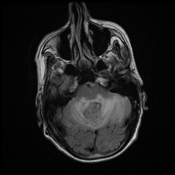 File:Cerebellar metastasis - lung tumor (Radiopaedia 69317-79147 Axial FLAIR 15).jpg