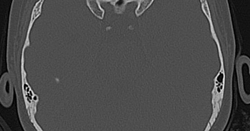 File:Cerebellopontine angle lipoma (Radiopaedia 57303-64242 Axial bone window 55).jpg