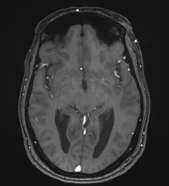 File:Cerebellopontine angle meningioma (Radiopaedia 72983-83680 Axial MRA 58).jpg
