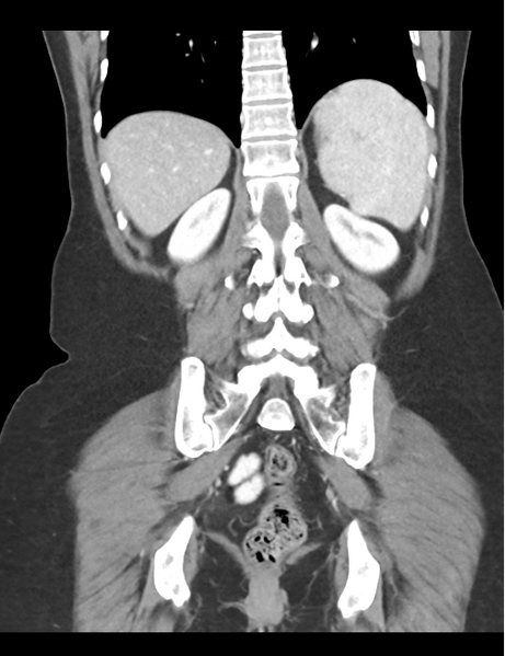 File:Cerebral abscess from pulmonary arteriovenous malformation (Radiopaedia 86275-102292 D 39).png