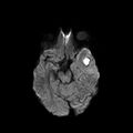 Cerebral abscess post cardiac surgery (Radiopaedia 27244-27420 Axial DWI 6).jpg