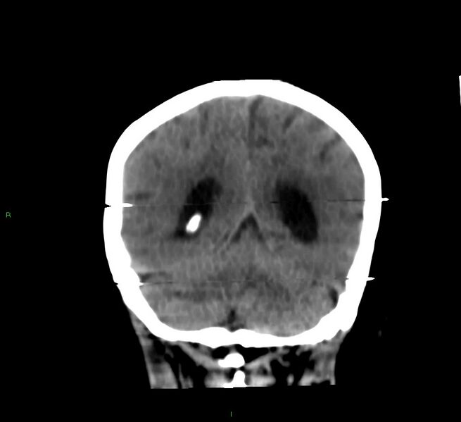 File:Cerebral amyloid angiopathy-associated lobar intracerebral hemorrhage (Radiopaedia 58377-65514 Coronal non-contrast 21).jpg