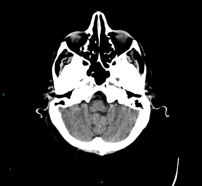 File:Cerebral amyloid angiopathy-associated lobar intracerebral hemorrhage (Radiopaedia 58529-65681 Axial non-contrast 42).jpg