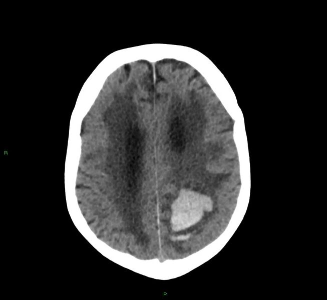 File:Cerebral amyloid angiopathy-associated lobar intracerebral hemorrhage (Radiopaedia 58530-65688 Axial non-contrast 15).jpg