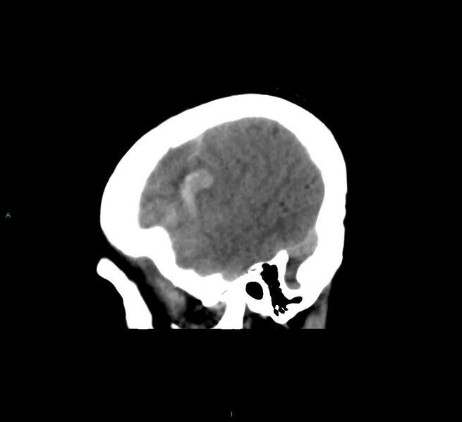 File:Cerebral amyloid angiopathy-associated lobar intracerebral hemorrhage (Radiopaedia 58561-65724 C 42).jpg
