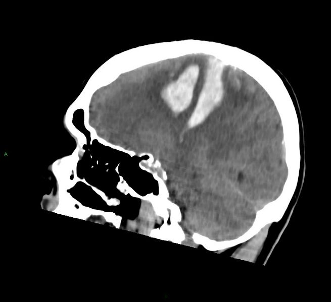 File:Cerebral amyloid angiopathy-associated lobar intracerebral hemorrhage (Radiopaedia 58756-65977 C 26).jpg