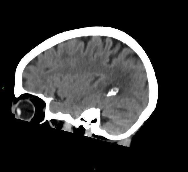 File:Cerebral amyloid angiopathy-associated lobar intracerebral hemorrhage (Radiopaedia 58757-65978 C 17).jpg