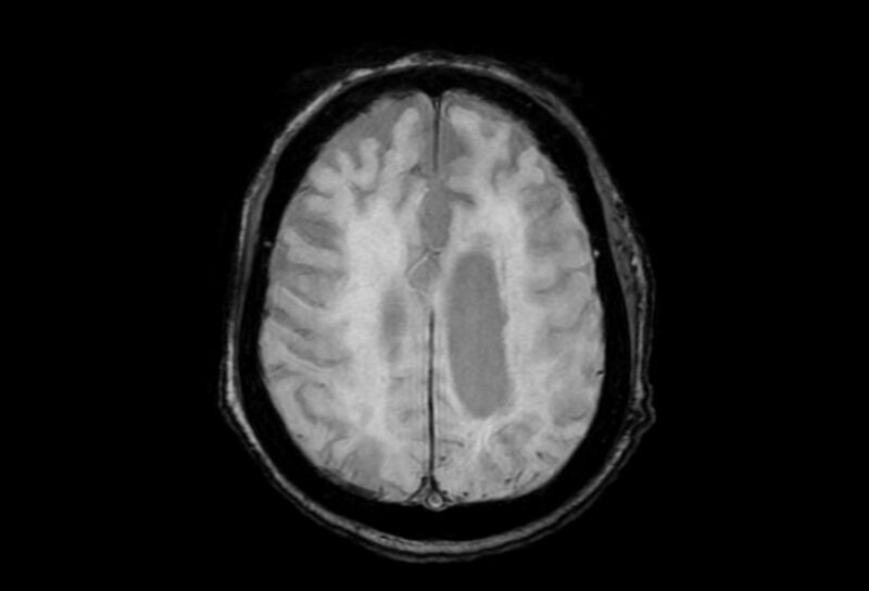 File:Cerebral amyloid angiopathy (Radiopaedia 86671-102792 Axial Gradient Echo 16).jpg
