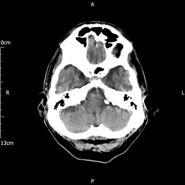 File:Cerebral amyloid angiopathy related inflammation (Radiopaedia 72772-83480 Axial non-contrast 6).jpg