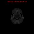 Cerebral and orbital tuberculomas (Radiopaedia 13308-13311 Axial DWI 9).jpg