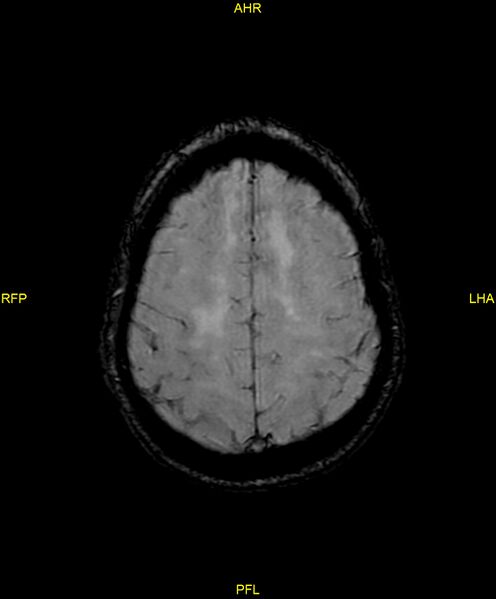 File:Cerebral autosomal dominant arteriopathy with subcortical infarcts and leukoencephalopathy (CADASIL) (Radiopaedia 86108-102054 Axial SWI 84).jpg