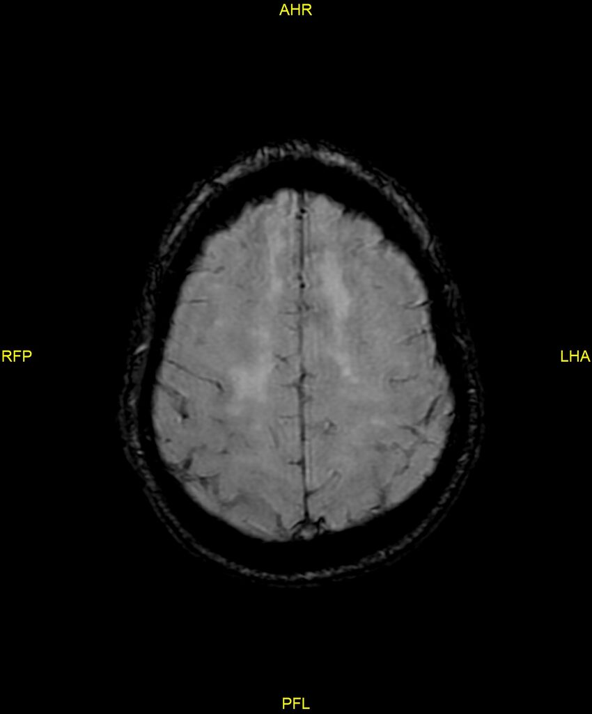 Cerebral autosomal dominant arteriopathy with subcortical infarcts and leukoencephalopathy (CADASIL) (Radiopaedia 86108-102054 Axial SWI 84).jpg
