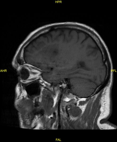 File:Cerebral autosomal dominant arteriopathy with subcortical infarcts and leukoencephalopathy (CADASIL) (Radiopaedia 86108-102054 Sagittal T1 19).jpg